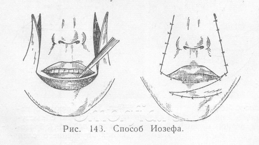 Как колоть губы схема