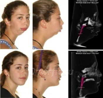 до и после микрогнатии
