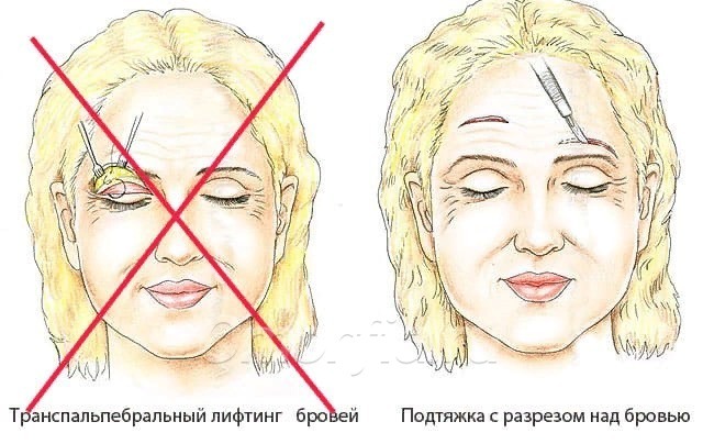 Подтяжка бровей. Эндоскопический лифтинг лба разрезы. Транспальпебральный лифтинг бровей. Височный лифтинг схема. Хирургическая подтяжка бровей.