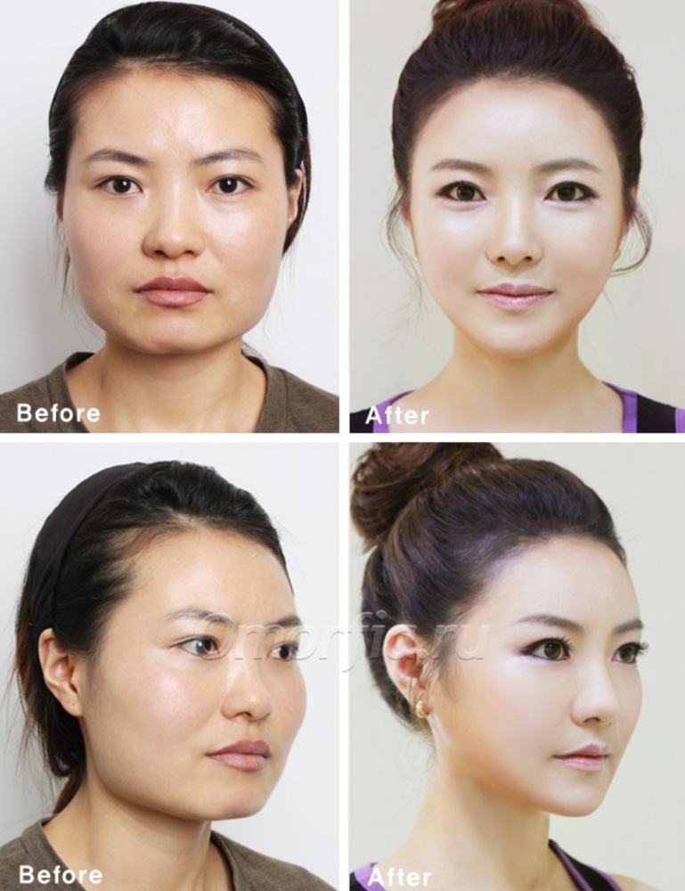 Изменение формы глаза. Азиатское лицо до и после пластики. Кореянки до и после пластики глаз. Пластика на глаза до и после у кореянок. Пластика азиатского лица.