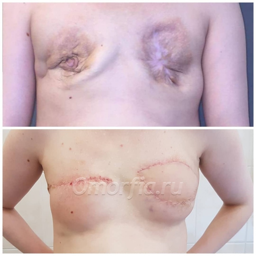 гематома в груди у женщин фото 60