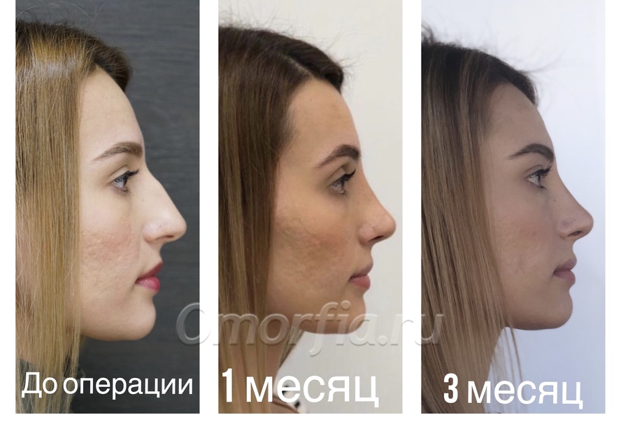 Реабилитационный период после ринопластики носа