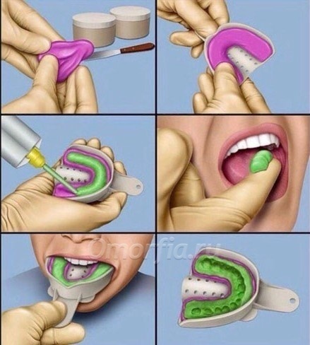 Пример того, как снимают слепки