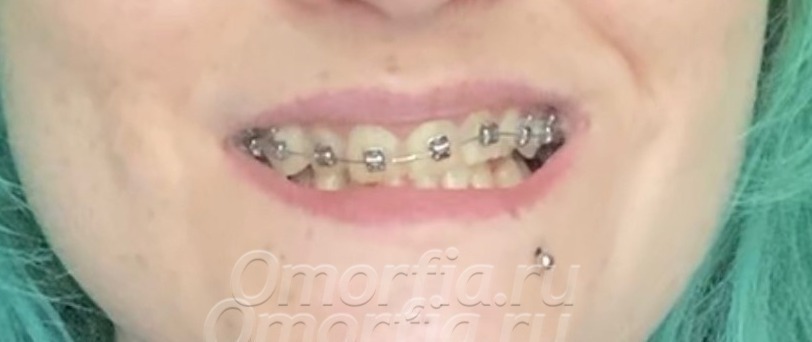 Установили брекеты на верхнюю челюсть