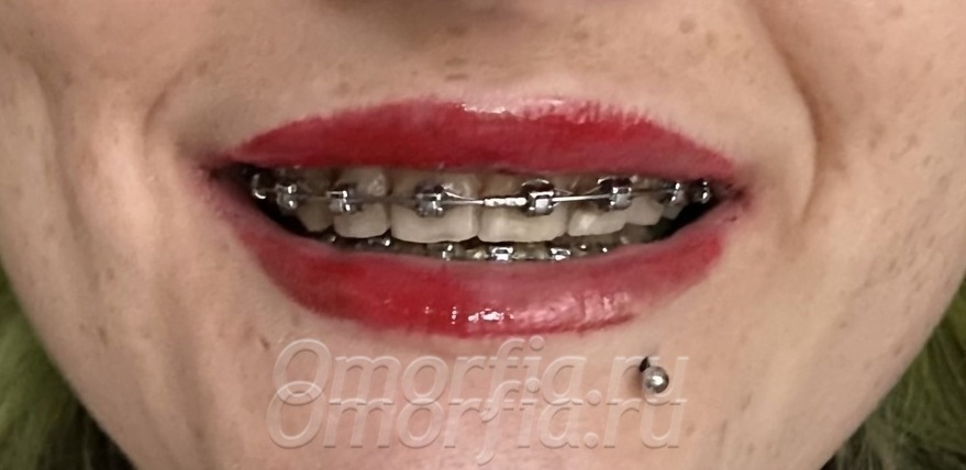 Мои зубы спустя 2,5 года