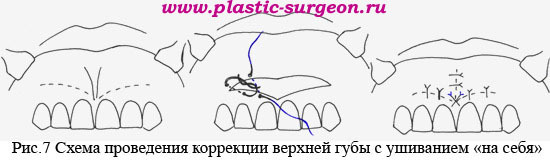 Десневая улыбка ботокс схема