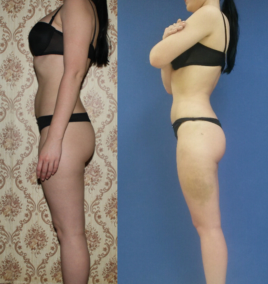 Лимфодренажный массаж результаты фото до и после