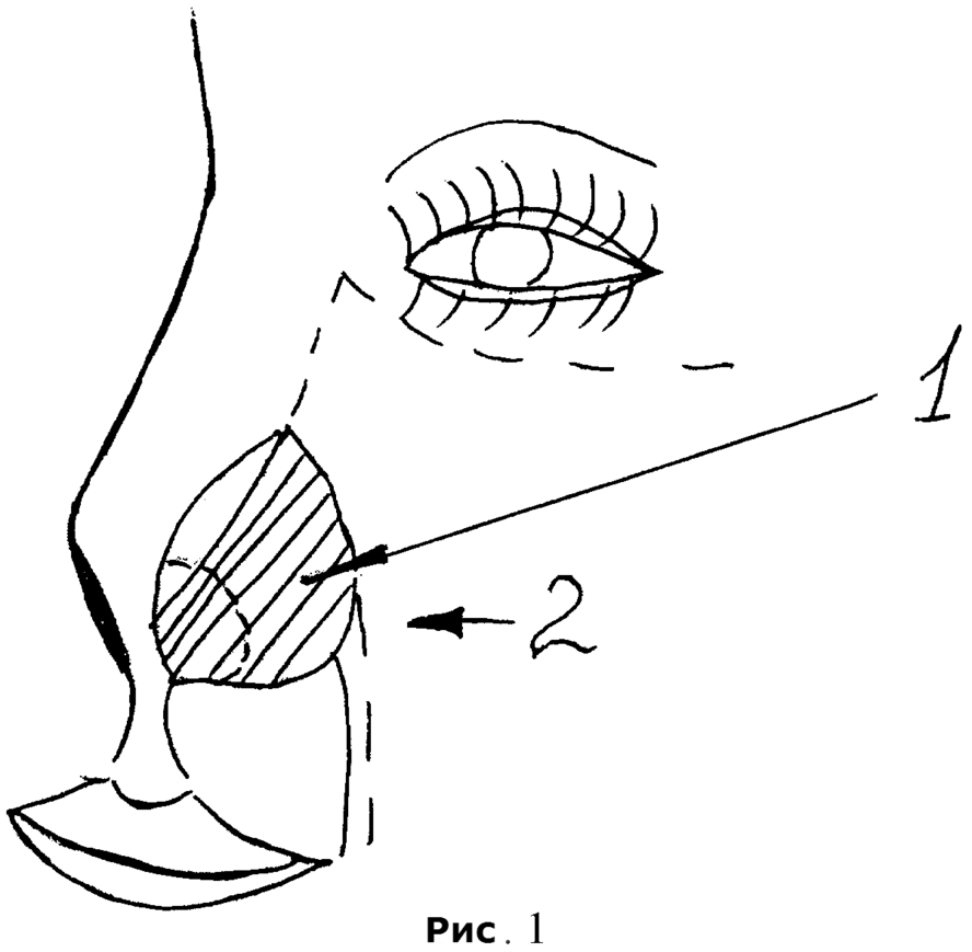 Пластика дефекта крыла носа.