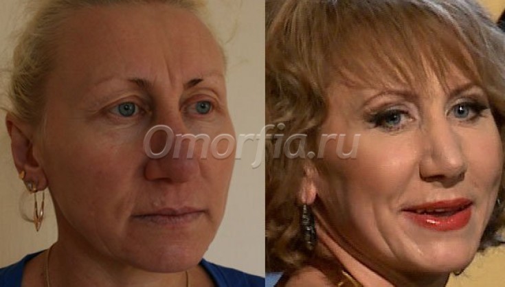 Оксана пушкина после неудачной пластики фото до и после